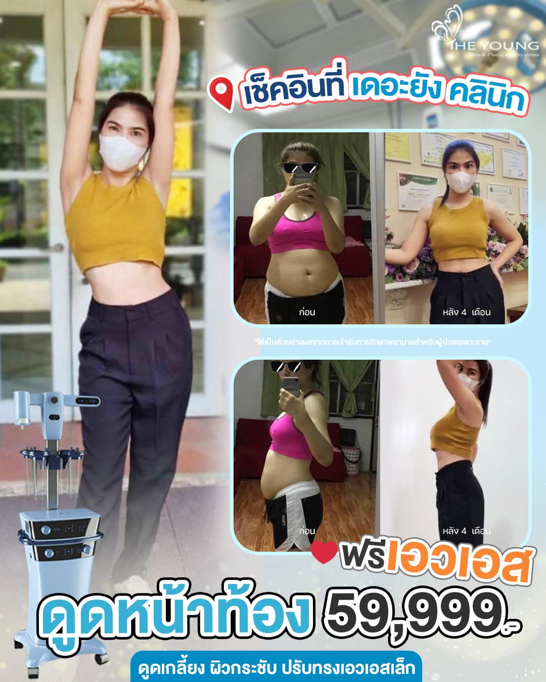 ดูดไขมัน