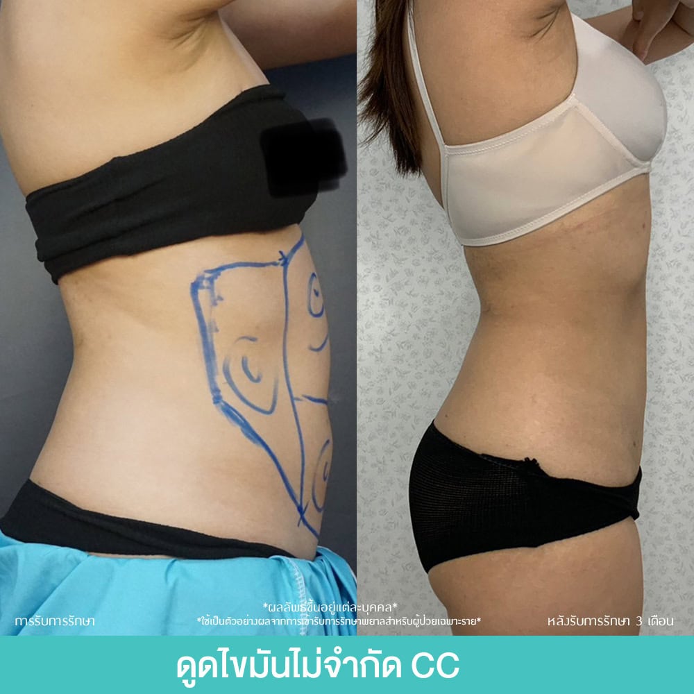 รีวิวดูดไขมันหน้าท้อง
