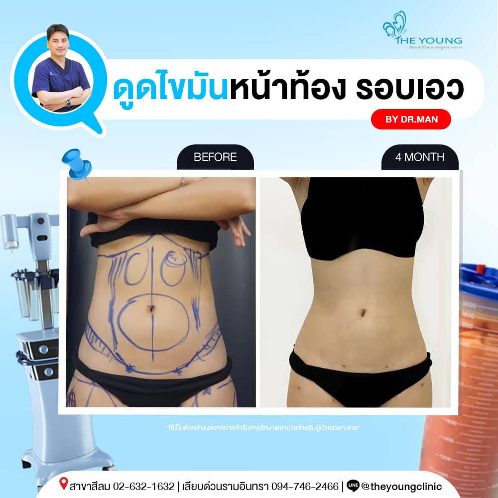 รีวิวดูดไขมันหน้าท้อง