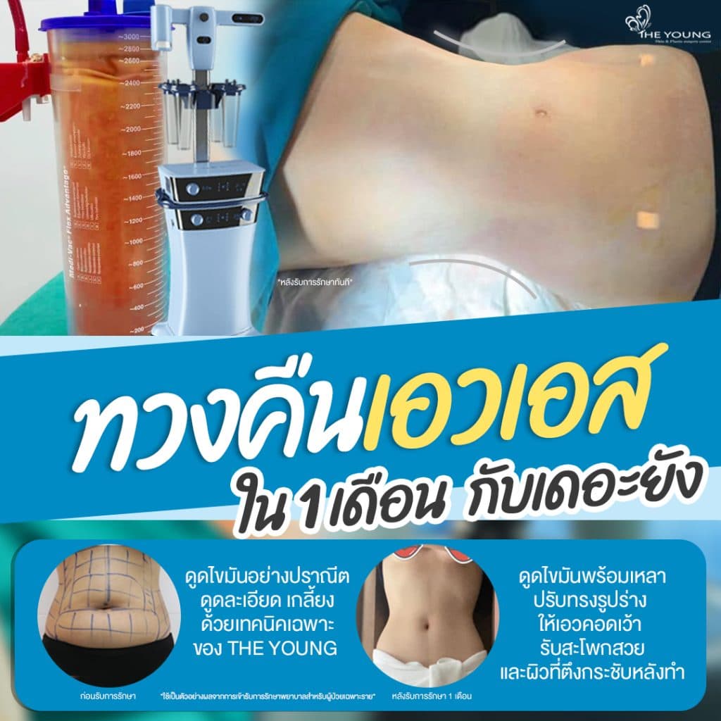 รีวิวดูดไขมันหน้าท้อง