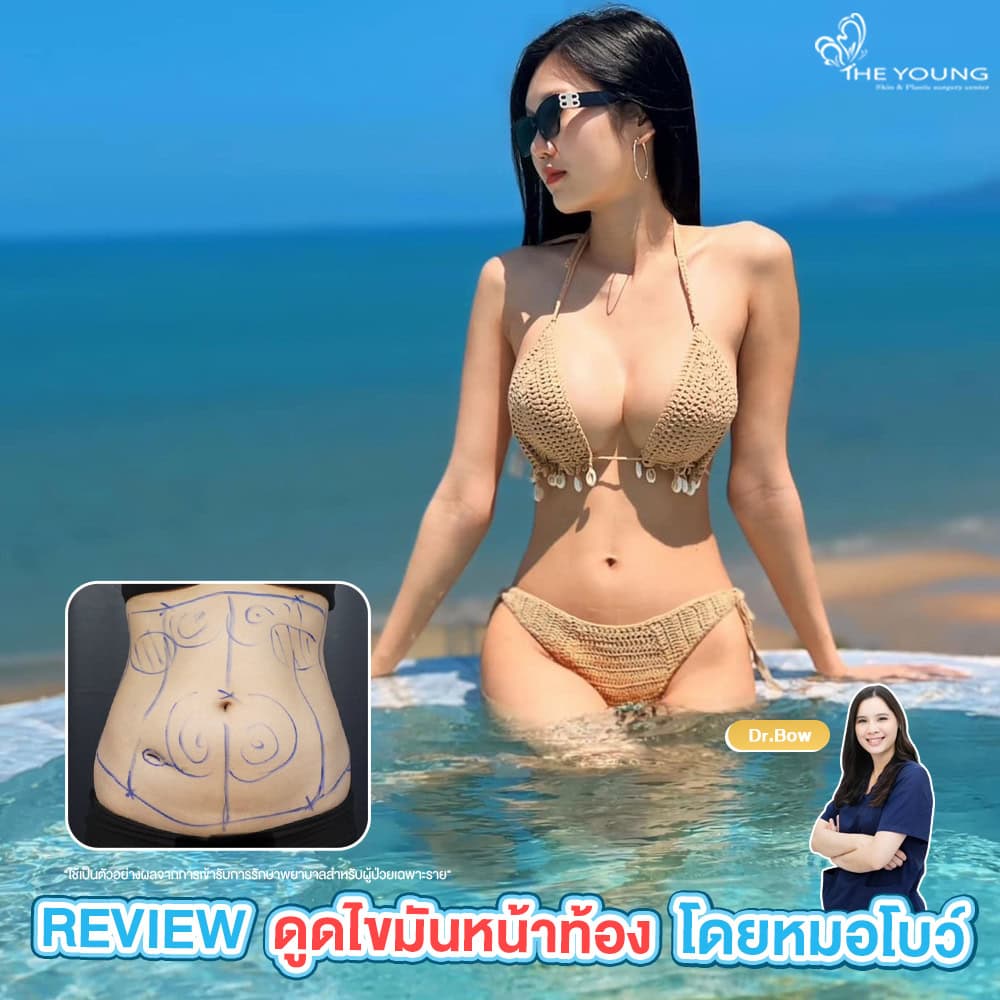 รีวิว ดูดไขมันหน้าท้อง