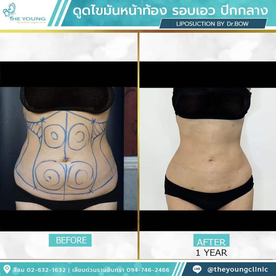 รีวิว ดูดไขมันหน้าท้อง