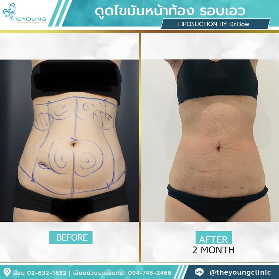 รีวิว ดูดไขมันหน้าท้อง