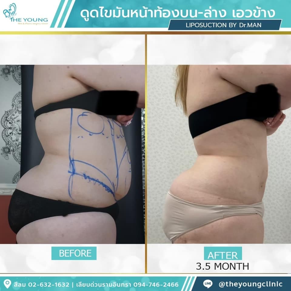 รีวิว ดูดไขมันหน้าท้อง