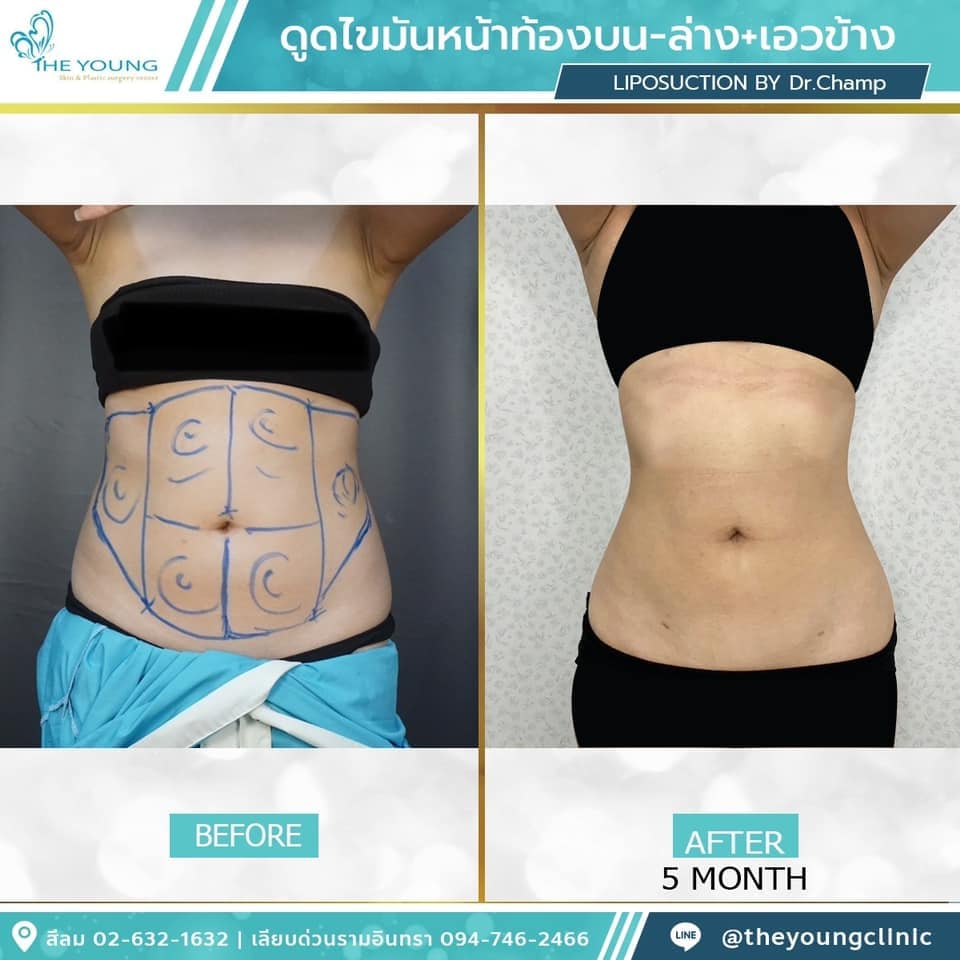 รีวิว ดูดไขมันหน้าท้อง