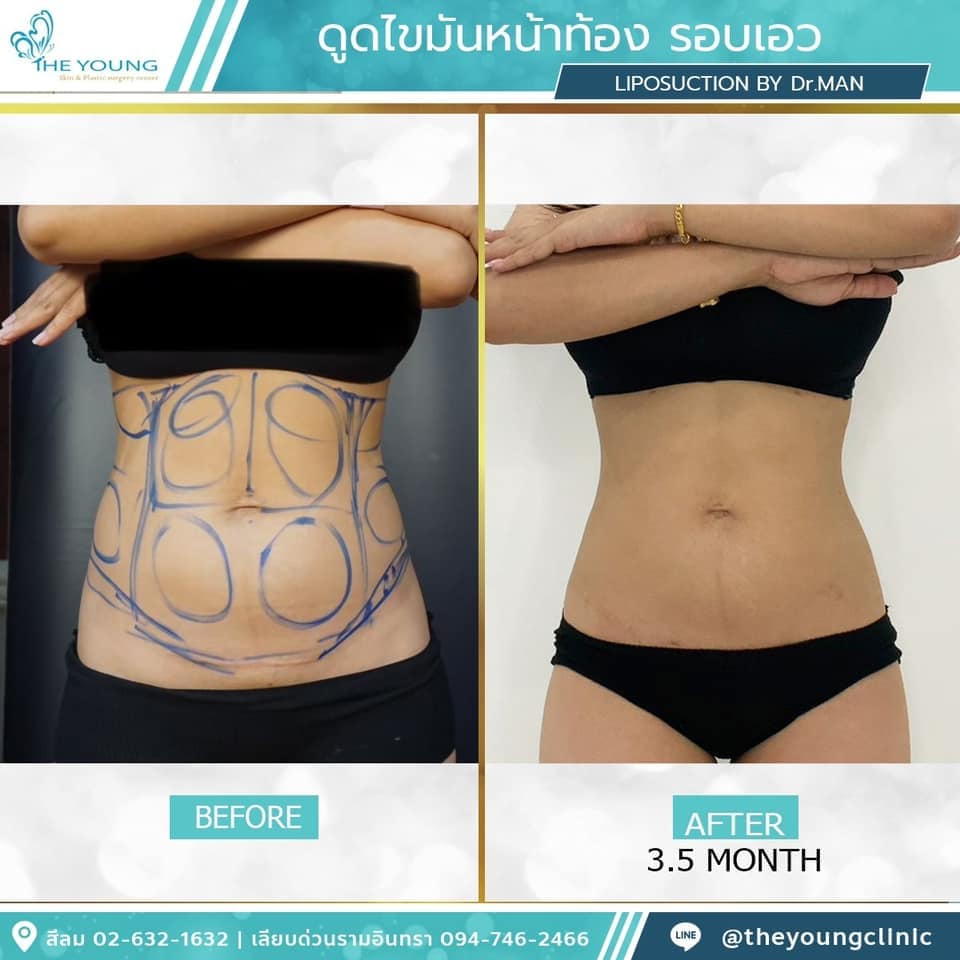 รีวิว ดูดไขมันหน้าท้อง