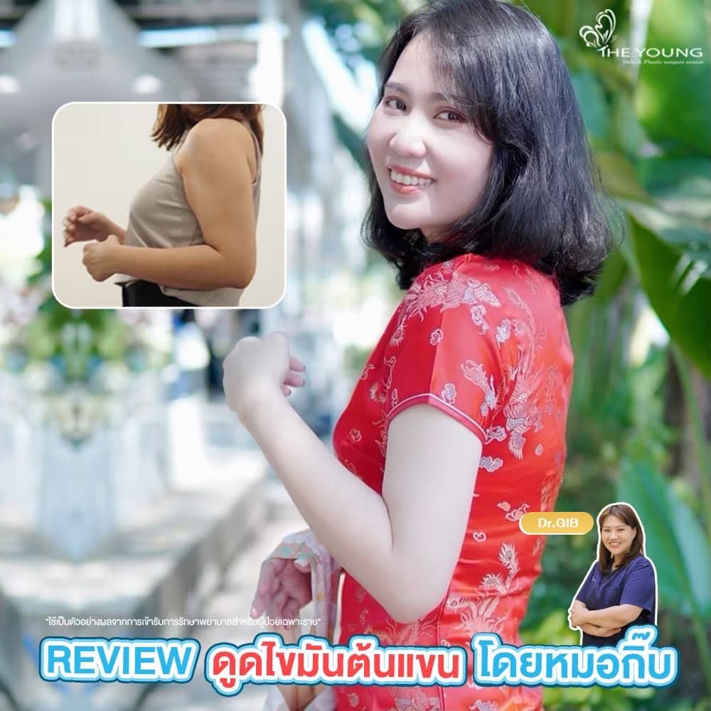 รีวิวดูดไขมัน ต้นแขน