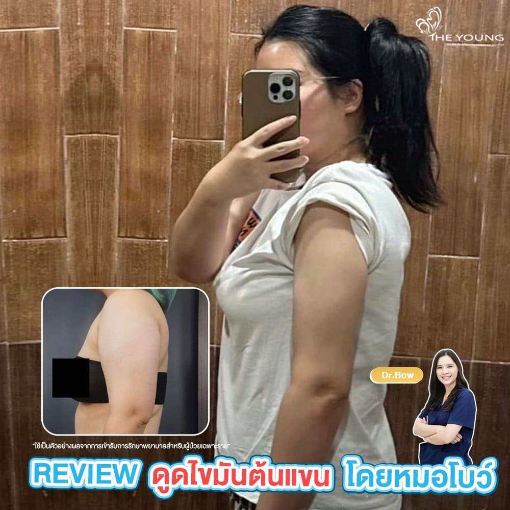 รีวิวดูดไขมันต้นแขน