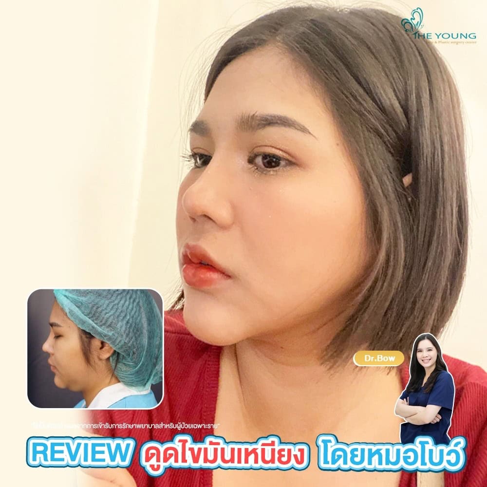 รีวิว ดูดไขมันเหนียง