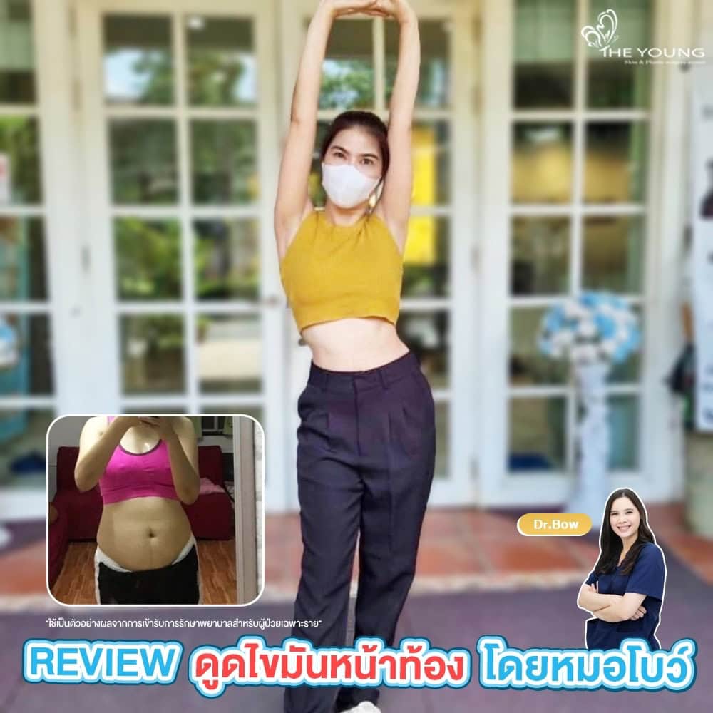 รีวิว ดูดไขมันหน้าท้อง
