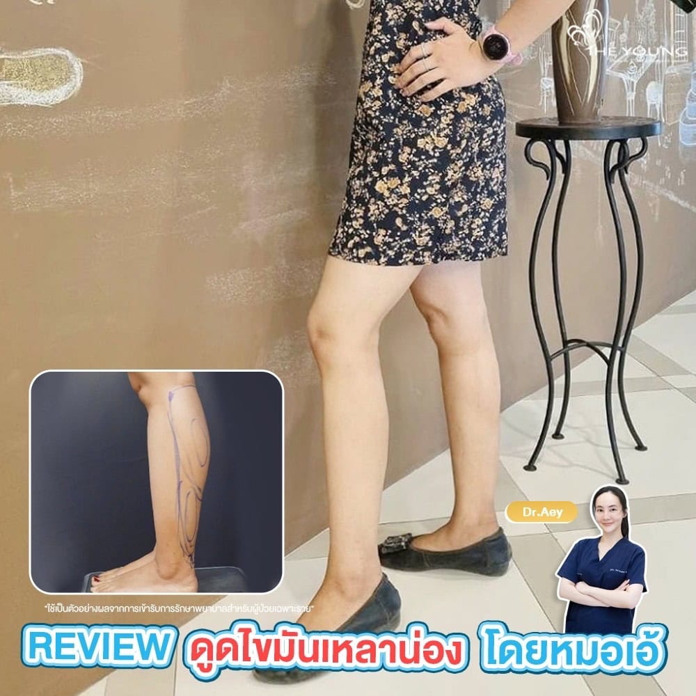 รีวิวดูดไขมันน่อง