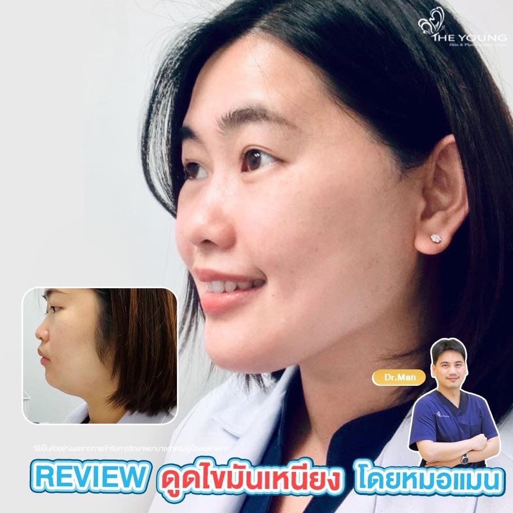 รีวิว ดูดไขมันเหนียง
