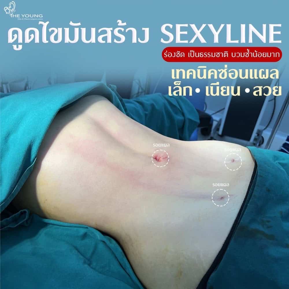 ดูดไขมันมัน sexyline