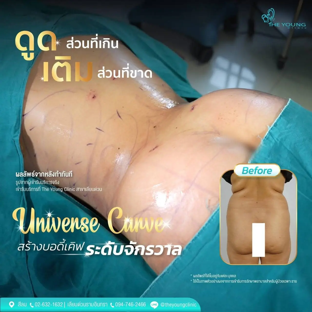 รีวิวเคสเสริมสะโพกด้วยไขมัน Universe Curve