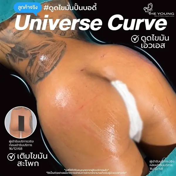 Universe Curve เห็นสัดส่วนชัดขึ้นได้จากเคสจริงที่ดูแลโดยแพทย์